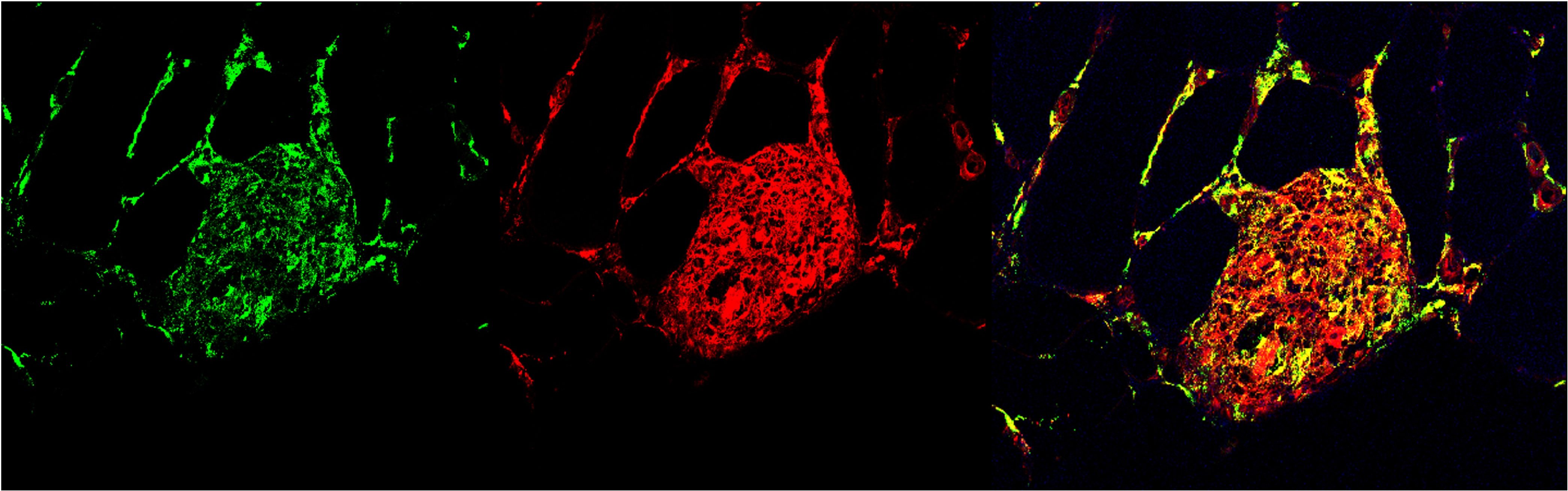 Double immunofluorescence with CD206 and CD68. The immunostaining shows CD206+ macrophages (green), CD68+ macrophages (red), and colocalization of CD206+ and CD68+ macrophages (yellow). Representative image of a localized infiltrate where most of CD68+ do not colocalize with CD206+ macrophages, showing an M1 predominance. Author: Andrea Bravo